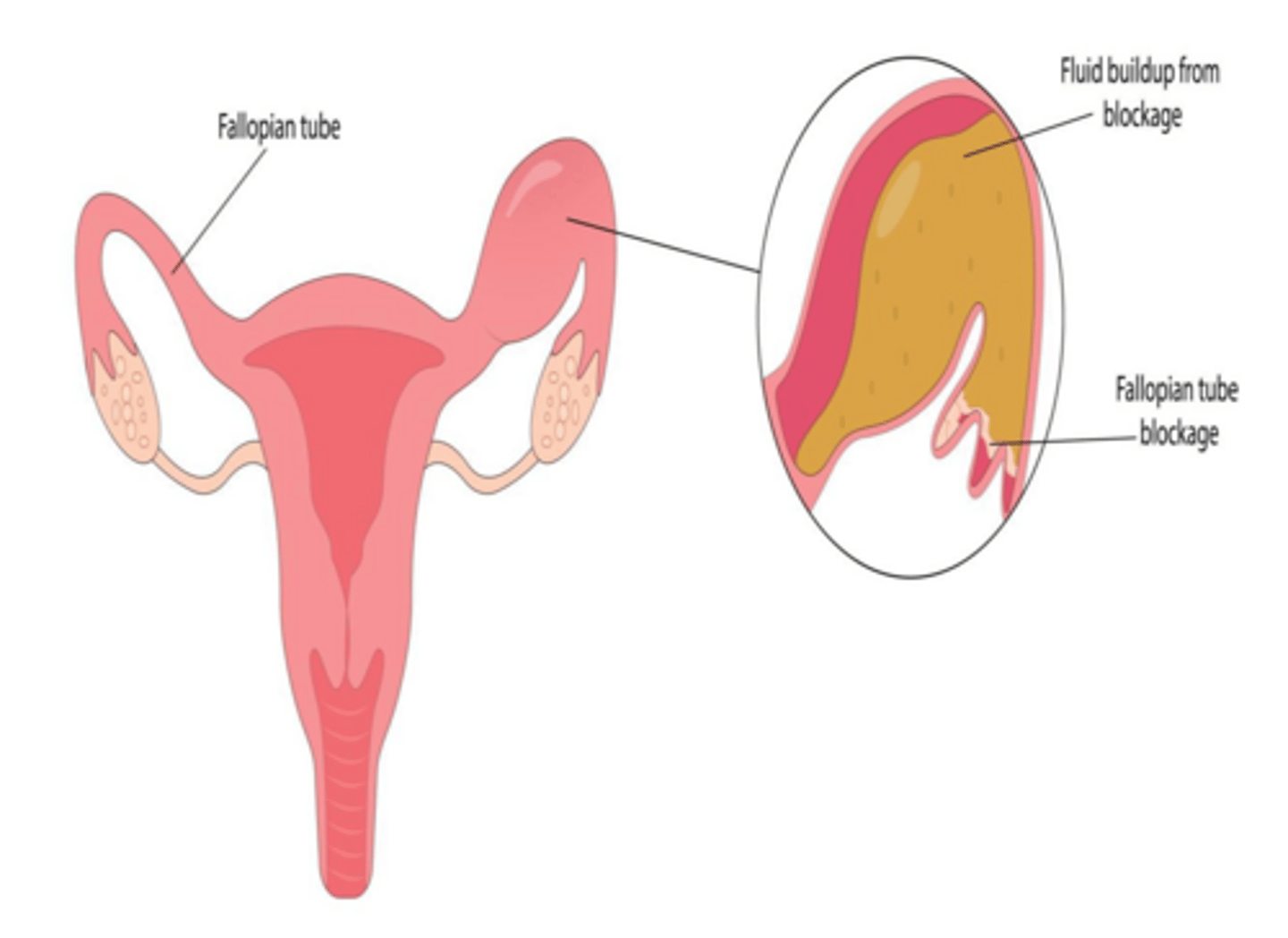 <p>Distension of the fallopian tube with fluid, usually due to distal blockage from prior PID, ectopic pregnancy, or surgery.</p>