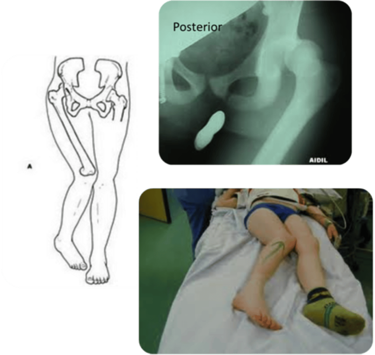 <p>Shortened</p><p>Flexed</p><p>ADDucted</p><p>Internal rotation</p>