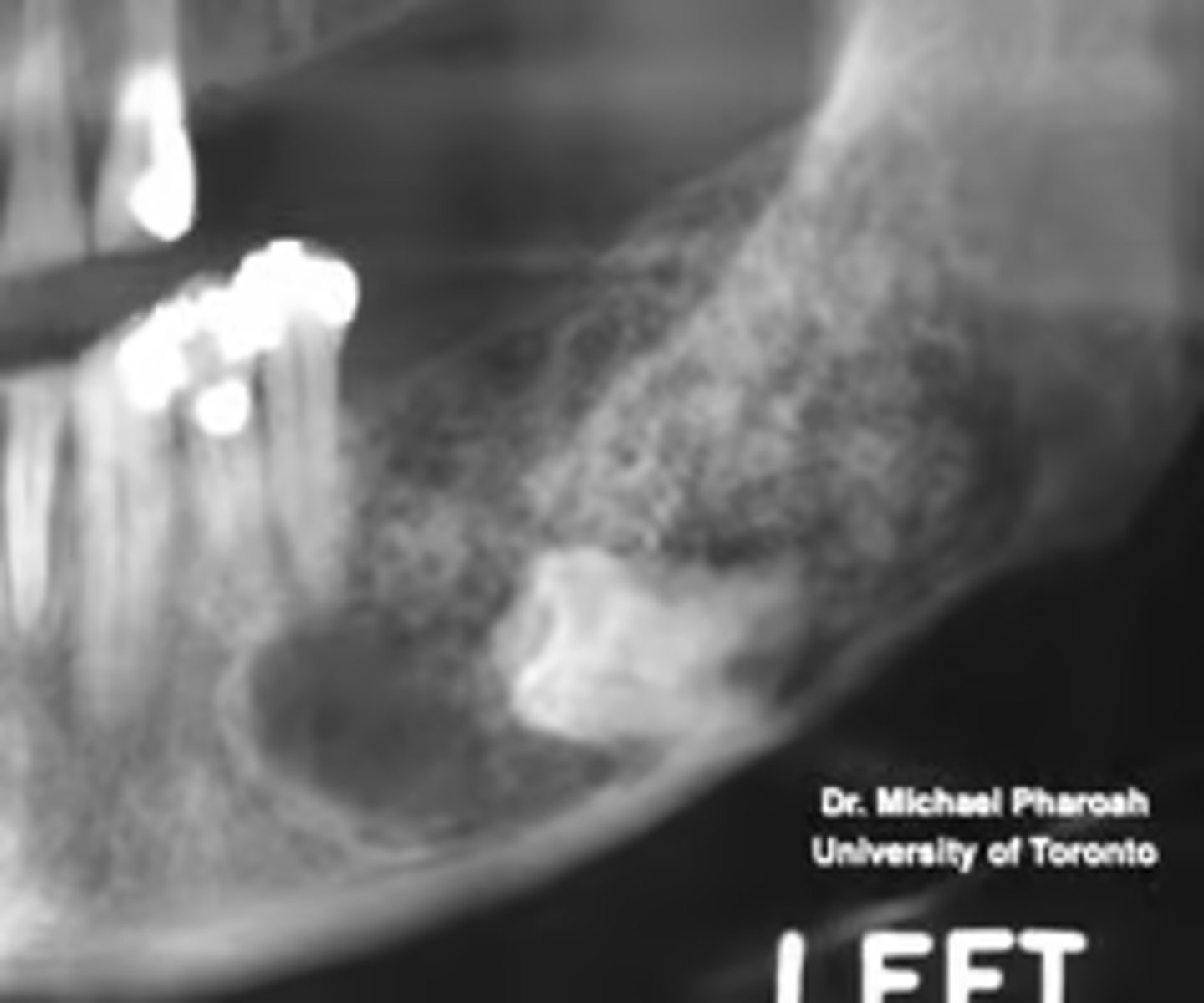 <p>What is the diagnosis?</p><p>Patient presents with an expansion on the posterior mandible. Radiograph shows a multilocular radiolucency containing calcifications within lesion and impacting the 3rd molar. Histopathology shows epithelial islands with calcifications that form concentric Liesegang rings.</p>
