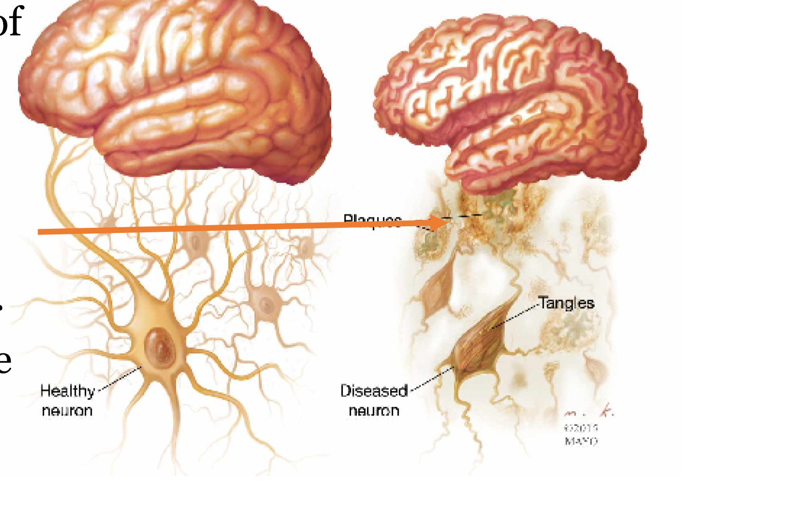 <p>genetic, environmental, structural abnormalities of brain such as plaques or tangles and loss of neurons </p>