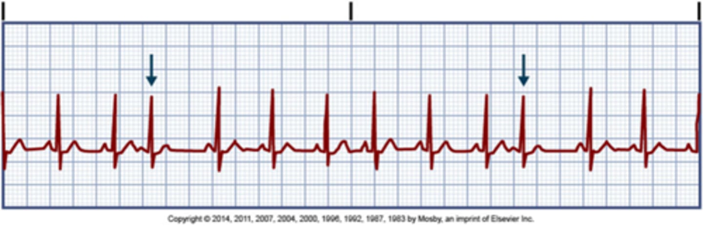 <p>Causes: stress, fatigue, caffeine, tobacco, alcohol, hypoxia, electrolytes</p><p>Manifestations: palpitations, "skips a beat"</p><p>Treatment: monitoring, withhold stimulants, beta blockers</p>