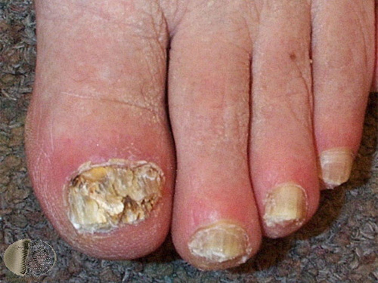 <p>diagnose this image:</p><p>Thickened yellow or white nails--> scaling under distal free edge</p>
