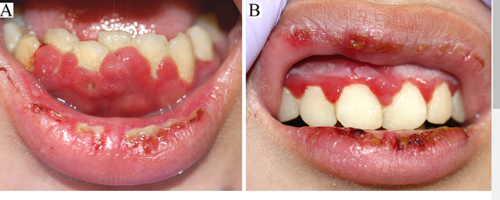 <p><span style="font-family: Droid Sans Mono, monospace">HERPETIC STOMATITIS</span></p>