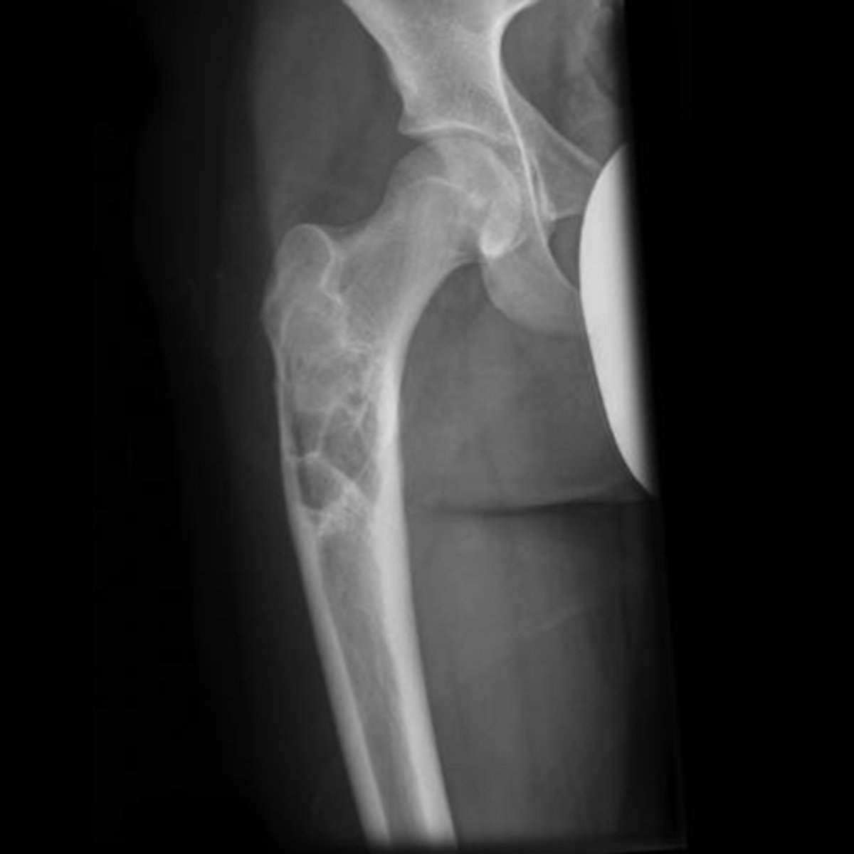 <p>State the radiographic features of simple bone cyst</p>