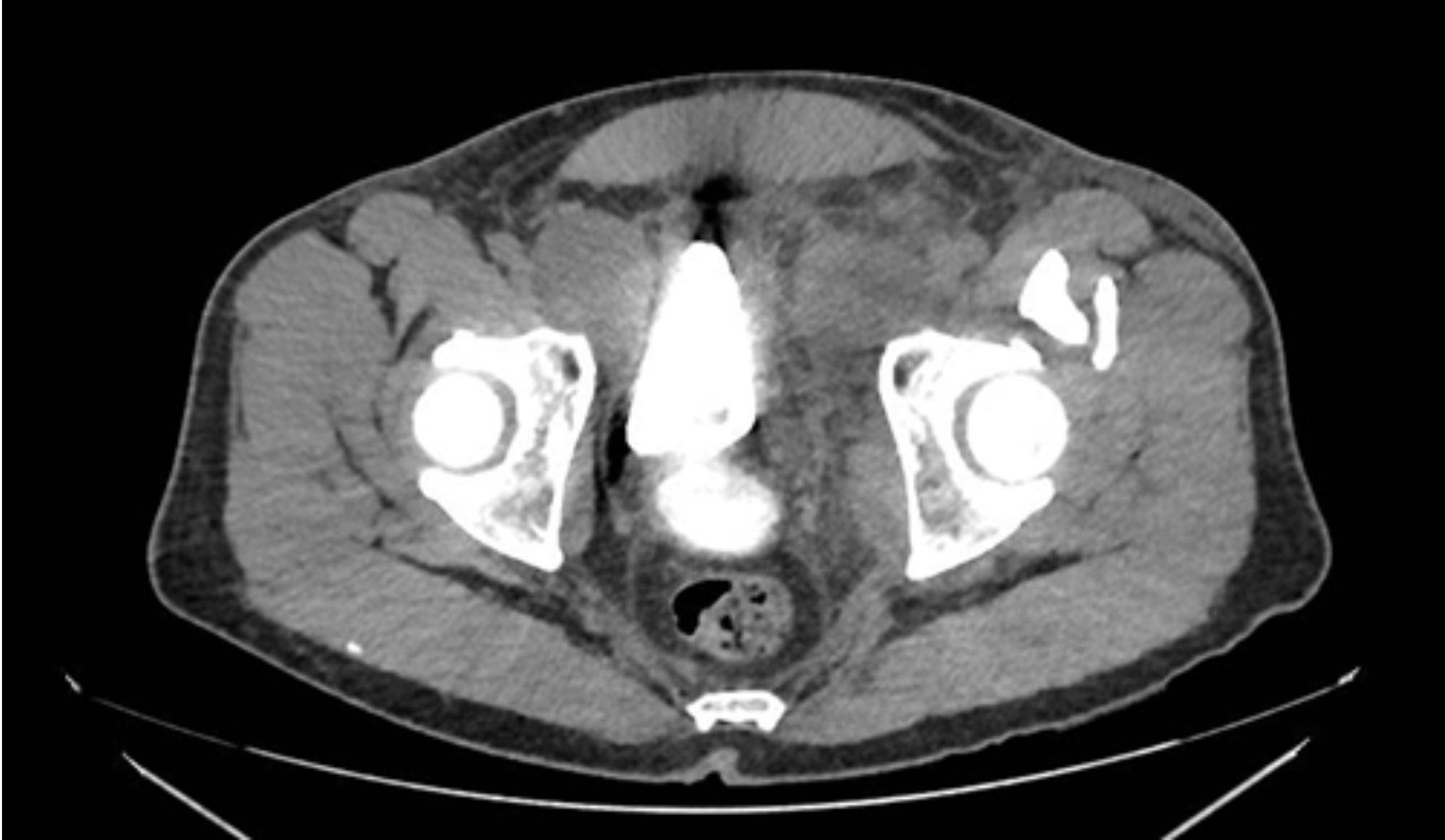 <p>2 weeks post prostatectomy, patient n/v, abdominal pain, and wbc what do we see in the imaging</p>