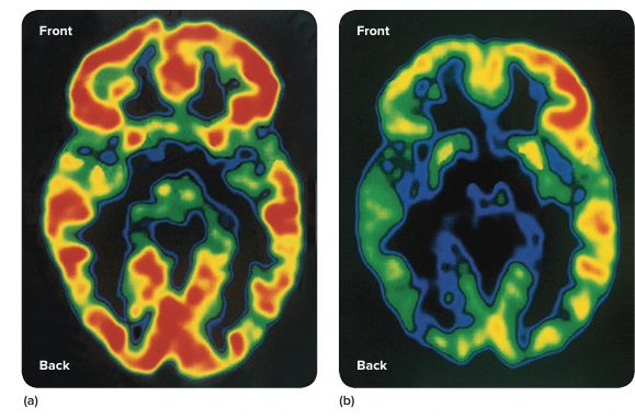 <ul><li><p>causes depressed brain activity</p></li><li><p>some damage can be reversed if caught early</p></li></ul><p></p>
