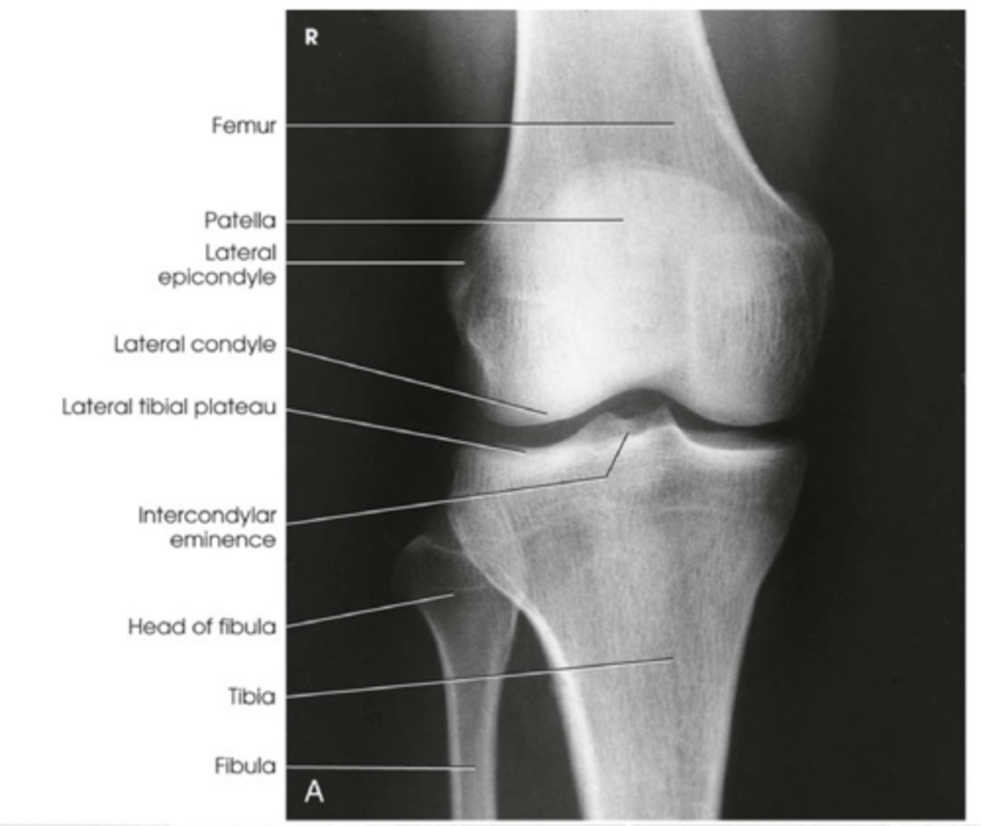 <p>tabletop parallel to the tibial plateau and essential in demonstrating an open joint space depending on body size</p>