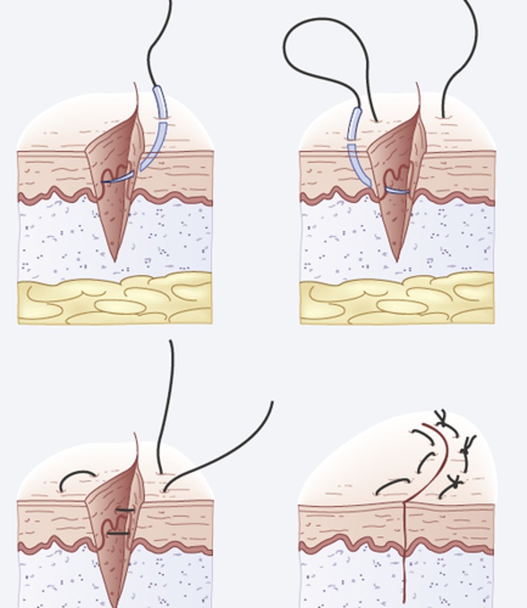 <p>D. CORRECT. Suturing requires surgical aseptic technique. The procedure is invasive, and the risk of infection is higher than it is during noninvasive procedures.</p><p>A. Aseptic technique is not necessary for cryosurgery because this procedure is less invasive than traditional surgery. The extremely low temperatures involved in cryosurgery prevent colonization by bacteria.</p><p>B. Aseptic technique is not necessary for a sonogram because the procedure is noninvasive.</p><p>C. Aseptic technique is not necessary for a sigmoidoscopy because the rectum and colon are colonized by bacteria.</p>
