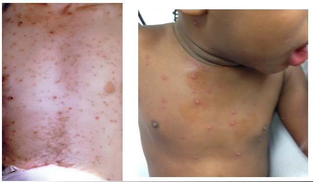 <p>Lesions <strong>develop in successive “crops”</strong>, meaning <strong>different stages</strong> of lesions are present <strong>at the same time</strong> on the body.</p>