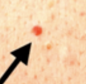 <p>Vascular Skin Lesion</p><ul><li><p>Common in <strong>elderly clients</strong> </p></li><li><p>angio means <strong>engorged arteriole</strong></p></li><li><p>a <strong>macule</strong></p></li></ul><p></p>