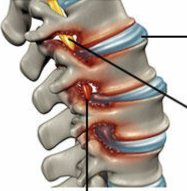 <p><strong><u>Narrowing</u></strong> or stricture of a <strong><u>passage or vessel </u></strong></p>