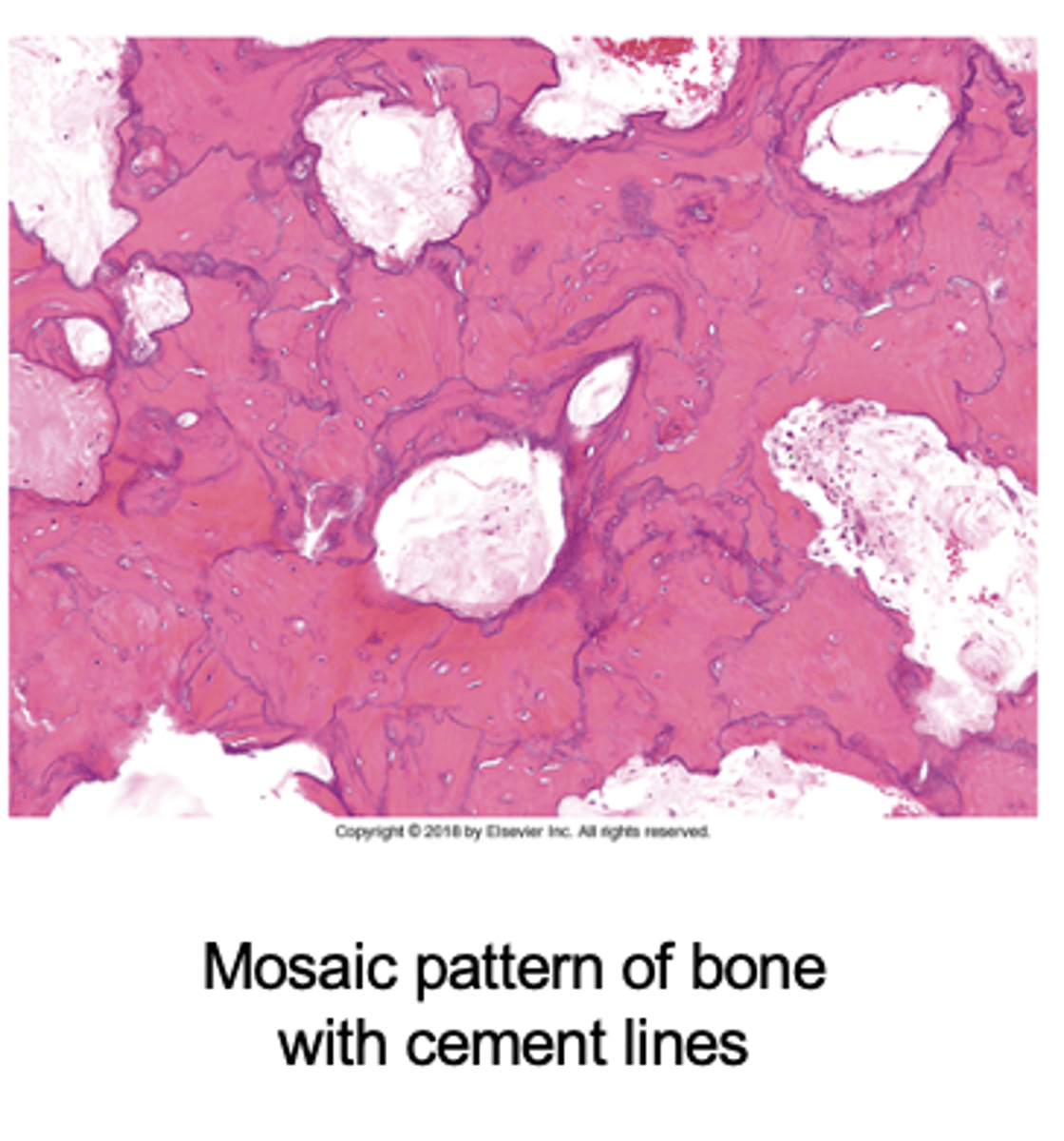 <p>The "mosaic" pattern outlines irregular patches of sclerotic lamellar bone reflecting previous waves of bone resorption and reformation.</p>