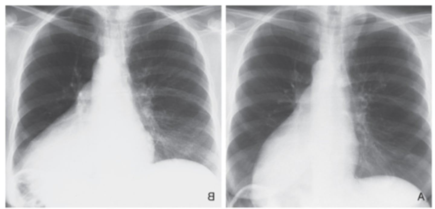 <p>-acute and marked enlargement of cardiac silhouette</p><p></p>