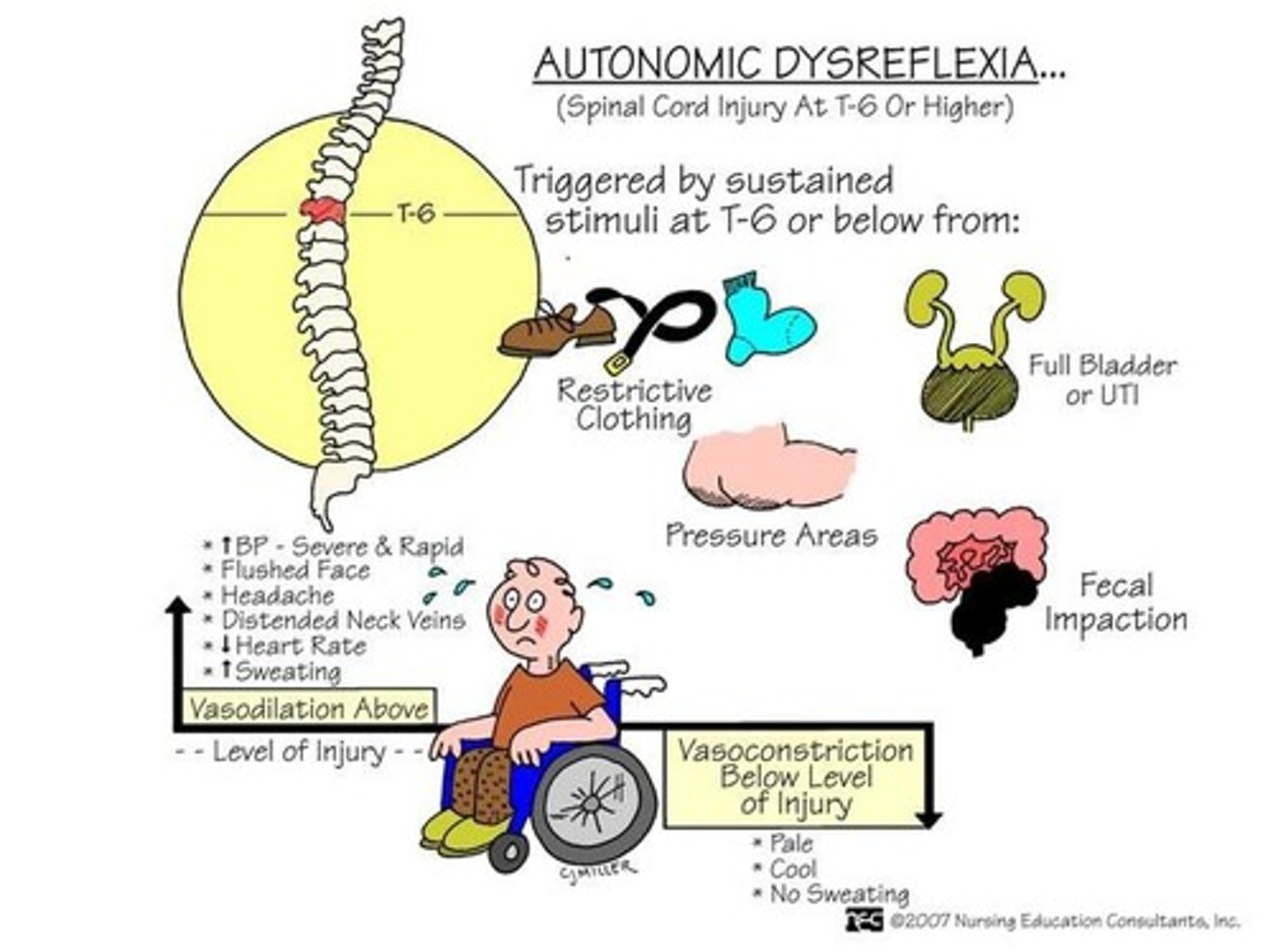 <p>It is a life-threatening condition that causes exaggerated autonomic responses to harmless stimuli, occurring in spinal cord injuries above T6.</p>