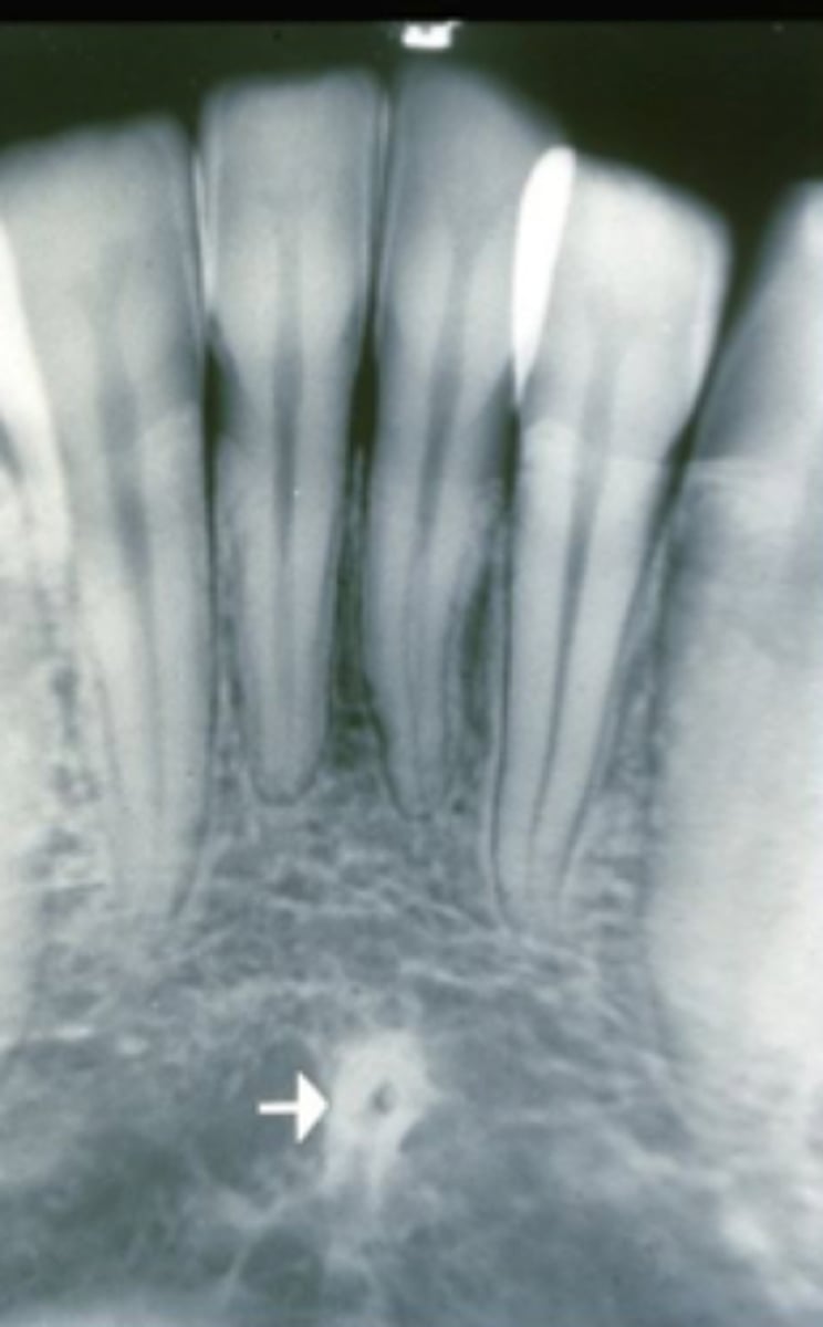 <p>bone spikes on the inner surface of the mandible</p><p>appear as a circle in images</p>