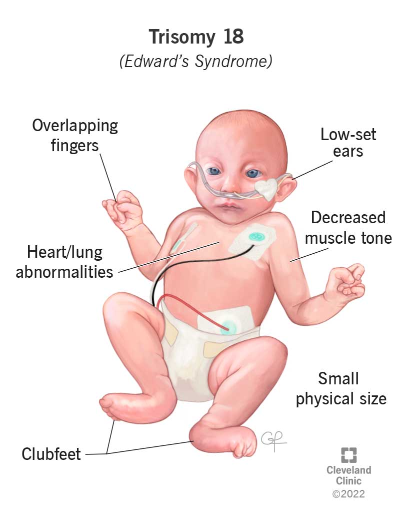 <ul><li><p>decreased muscle tone (hypotonia)</p></li><li><p>low-set ears</p></li><li><p>internal organs forming or functioning differently </p></li><li><p>severe cognitive/ intellectual development</p></li><li><p>overlapping fingers and/or clubfeet</p></li></ul>