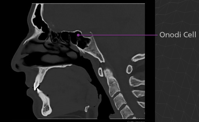 <p>An Onodi cell is a posteriorly location ethmoid air cell, occurring extremely close to the optic nerve and sometimes the internal carotid artery. It is clinically significant due to its proximity to vital structures and potential complications during sinus surgery. If a surgeon goes through an Onodi cell rather than the posterior ethmoid cell, the optic nerve may be damaged.</p>