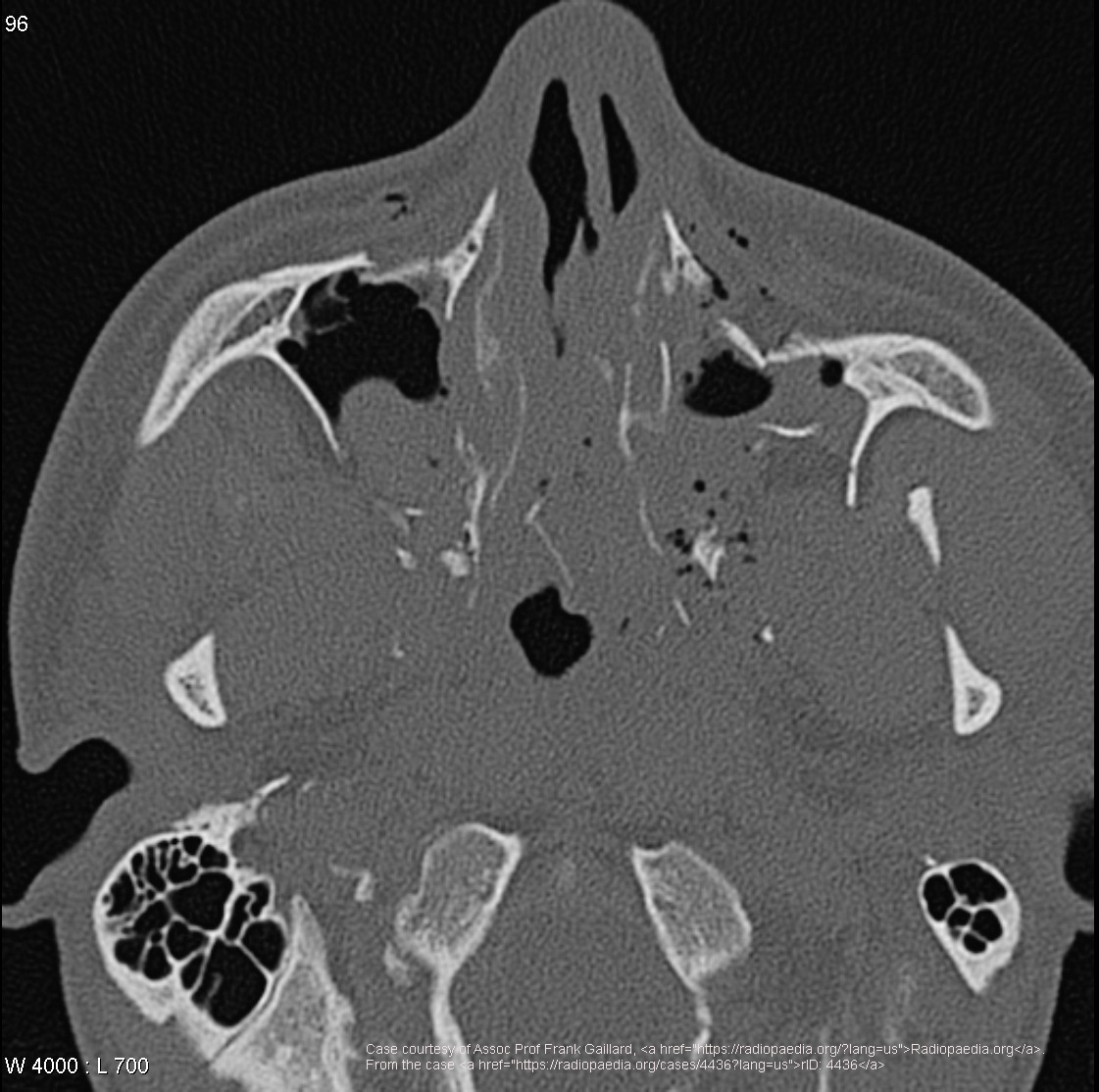 <p>Type I (horizontal), Type II (pyramidal), Type III (transverse).</p>