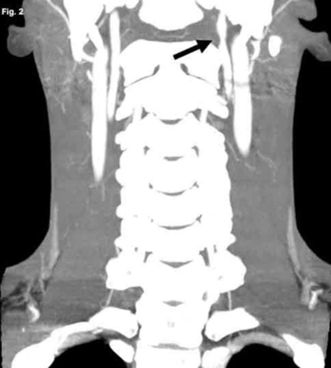 <p>CN 7, 9, 10 = change in taste in the ant 2/3 tongue, post 1/3 tongue, larynx</p>