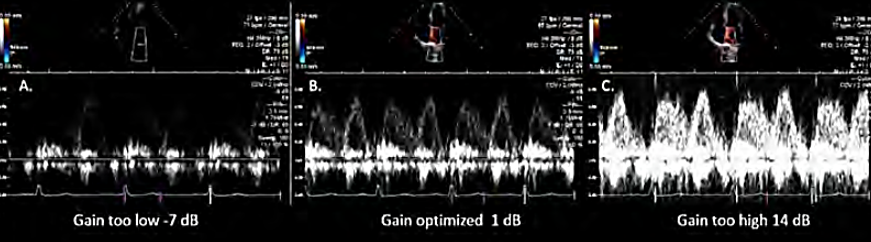 <p><strong>amplifies doppler signals</strong></p><p>to help measure accurately</p>