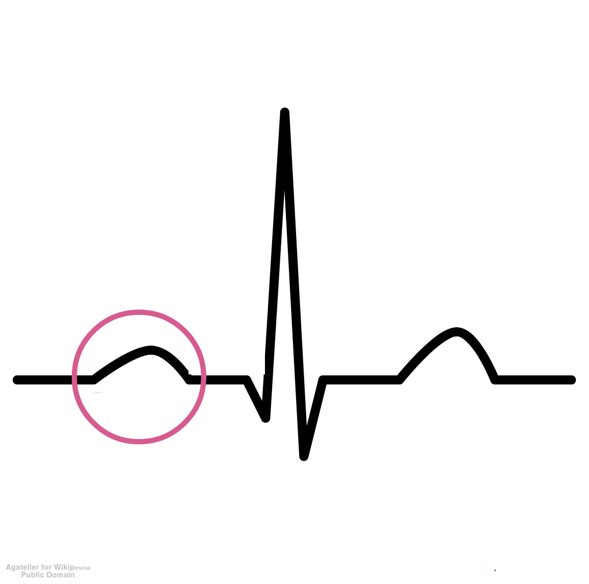 <p>Represents atrial depolarization; the first deflection of an EKG wave.</p>