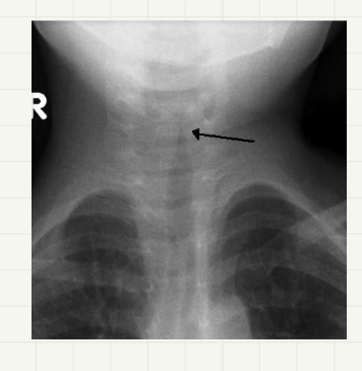 <p>laryngomalacia dx/tx</p>