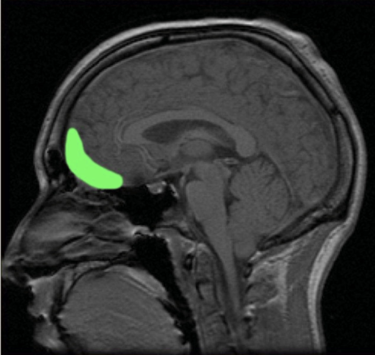 <p>- one of the functional parts of the prefrontal cortex, sometimes called ventromedial</p>
