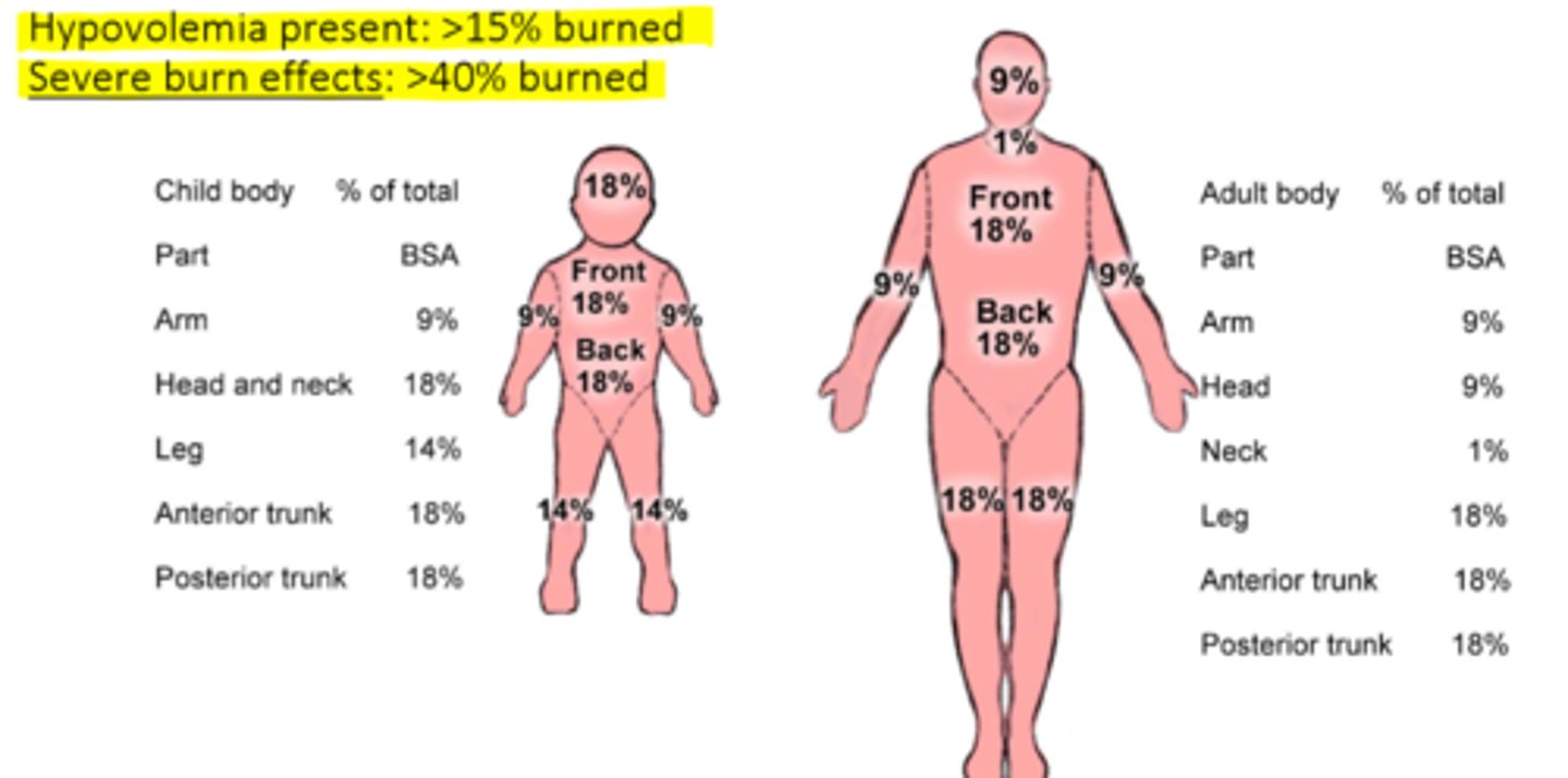 <p>- tells us the extent of injury in a burn (superficial burn not counted) => add up the % of burned areas on body surface and round up to determine needed fluid resuscitation (palm approximates 1%)</p><p>- hypovolemia present: >15% burned</p><p>- severe burn effects: >40% burned</p>