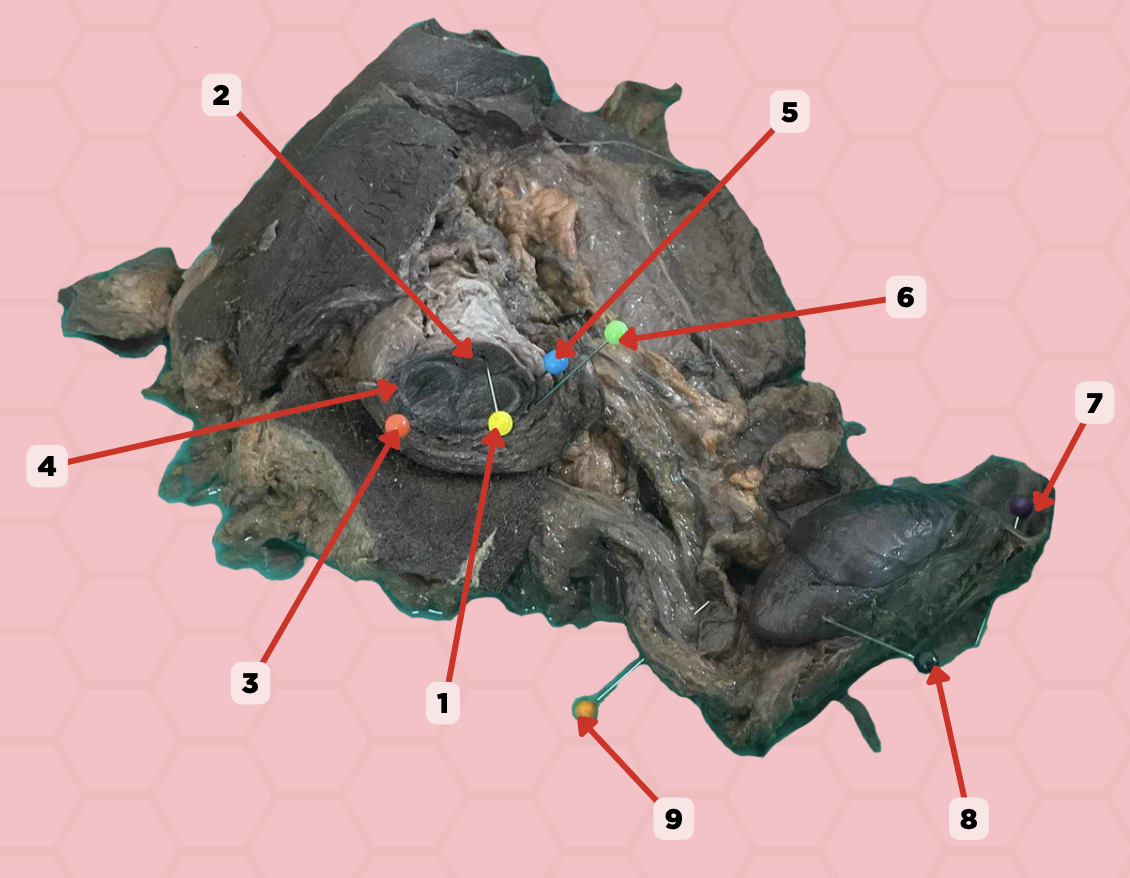 <p>Structure #9 is a part of the spermatic cord. Where does the spermatic cord begin and what is the name of structure #9 that joins this cord?</p><p>a. Superficial inguinal ring; testicular artery</p><p>b. Deep inguinal ring of the abdominal ring; vas deferens</p><p>c. Inguinal canal; pampiniform plexus</p><p>d. External spermatic fascia; urethra</p>
