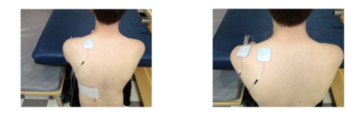 <p>stimulation will cause some head/neck rotation</p><p>can also place electrode over posterior cervical musculature</p><p>2 pps, 400 microsecs. 1 min on/1 min off, 10 min duration</p>