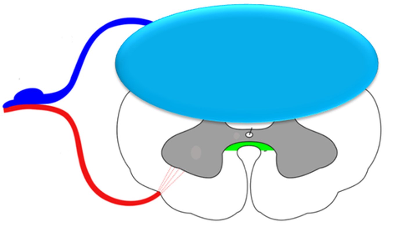 <p>You would be more likely to see decreased sensation because sensory neurons enter the spinal cord posteriorly.</p>