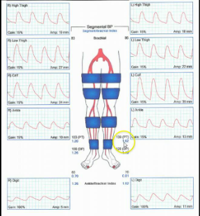 <p>Patient has hx of HTN, CAD, DM and PAD. Please answer following:</p><p>1.What are these medical acronyms and why are they important? </p><p>2.Considering patient history can we rely on ABI information? Why or why not? </p><p>3.Which LE pressures are most accurate for this patient? </p>