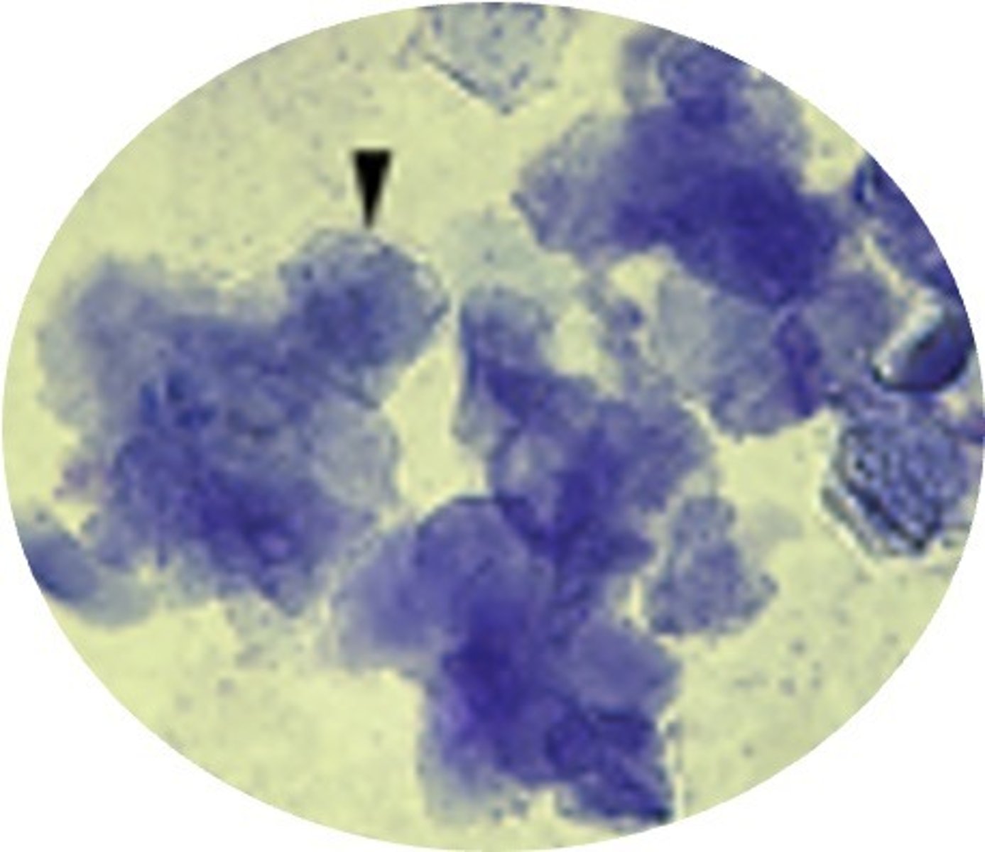 <ul><li><p>Almost 70-100% cornfield cell (anuclear and superficial)</p></li><li><p>No neutrophils &amp; very clear background</p></li></ul><p></p>
