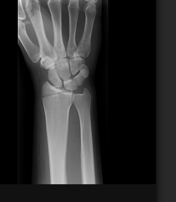 <p>Fracture of the radial styloid</p>