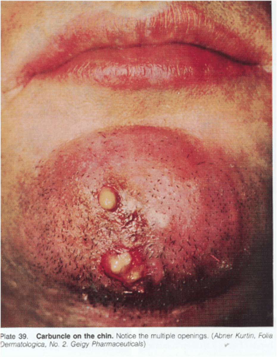 <p>name this skin pathology</p>