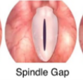 <p><span>•Gap in the mid 1/3 portion of membranous glottis</span></p>