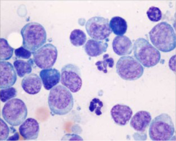 <p>What is your cytologic diagnosis?</p><p>A. Reactive LN</p><p>B. Suppurative inflammation with bacterial sepsis </p><p>C. Normal LN</p><p>D. Lymphoma </p>