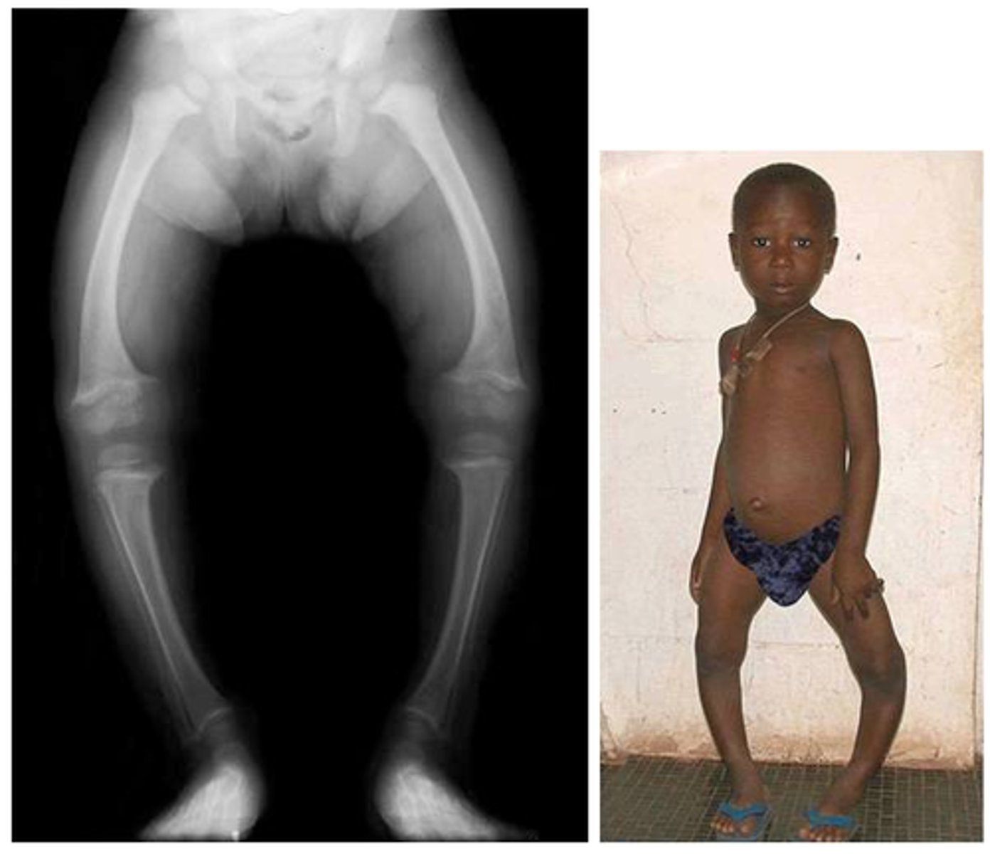 <p>- disease in children causing soft or weak bones</p><p>- caused by vitamin d defiency or lack of sun exposure</p><p>- presents with bone deformities such as bowed legs and a widened epiphyses due to stresses of weight bearing</p>