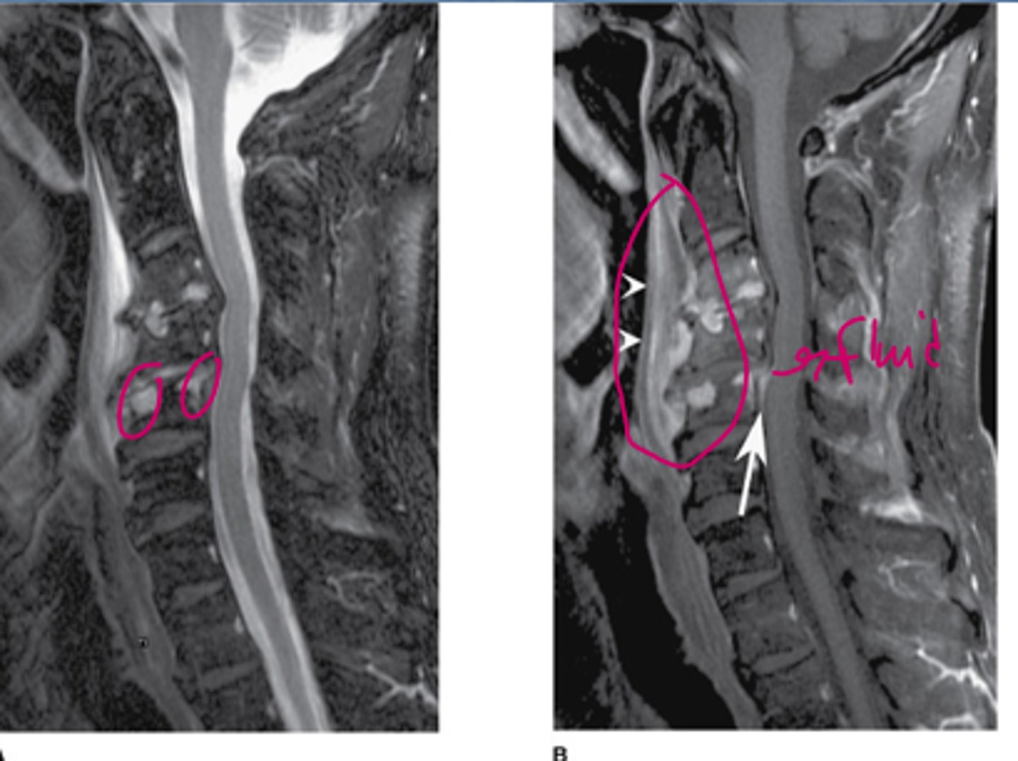 <p>What is the most likely diagnosis?</p><p>Spine metastases</p><p>Posttraumatic changes</p><p>Discitis and osteomyelitis</p><p>Epidural abscess</p><p>Degenerative changes</p>