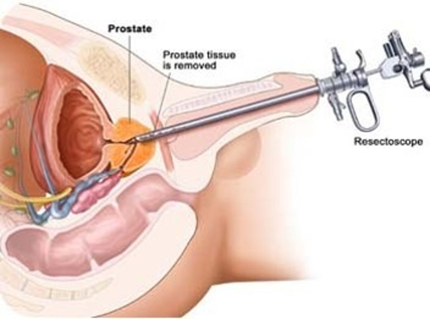 <p>surgical removal of pieces of the prostate gland tissue by using an instrument through the urethra.</p><p>-The capsule is left intact; usually performed when the enlarged prostate gland interferes with urination</p><p>-for benign prostatic hyperplasia</p>