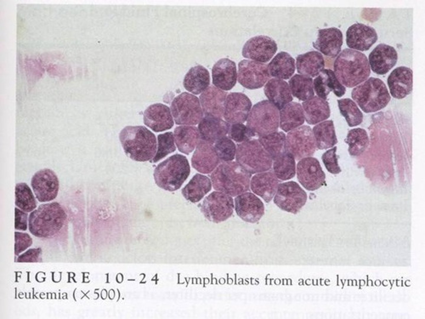 <p>-major clinical significance: disseminated lymphomas</p><p>-microscopic findings: resemble lymphocytes with cleft nuclei</p>