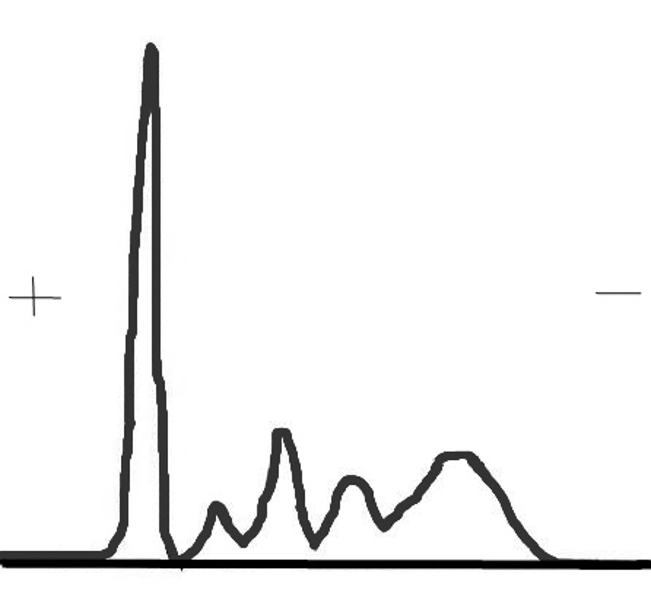 <p>This serum protein electrophoresis scan most likely represents which condition?</p>