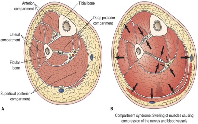 <p>compartment syndrome</p>
