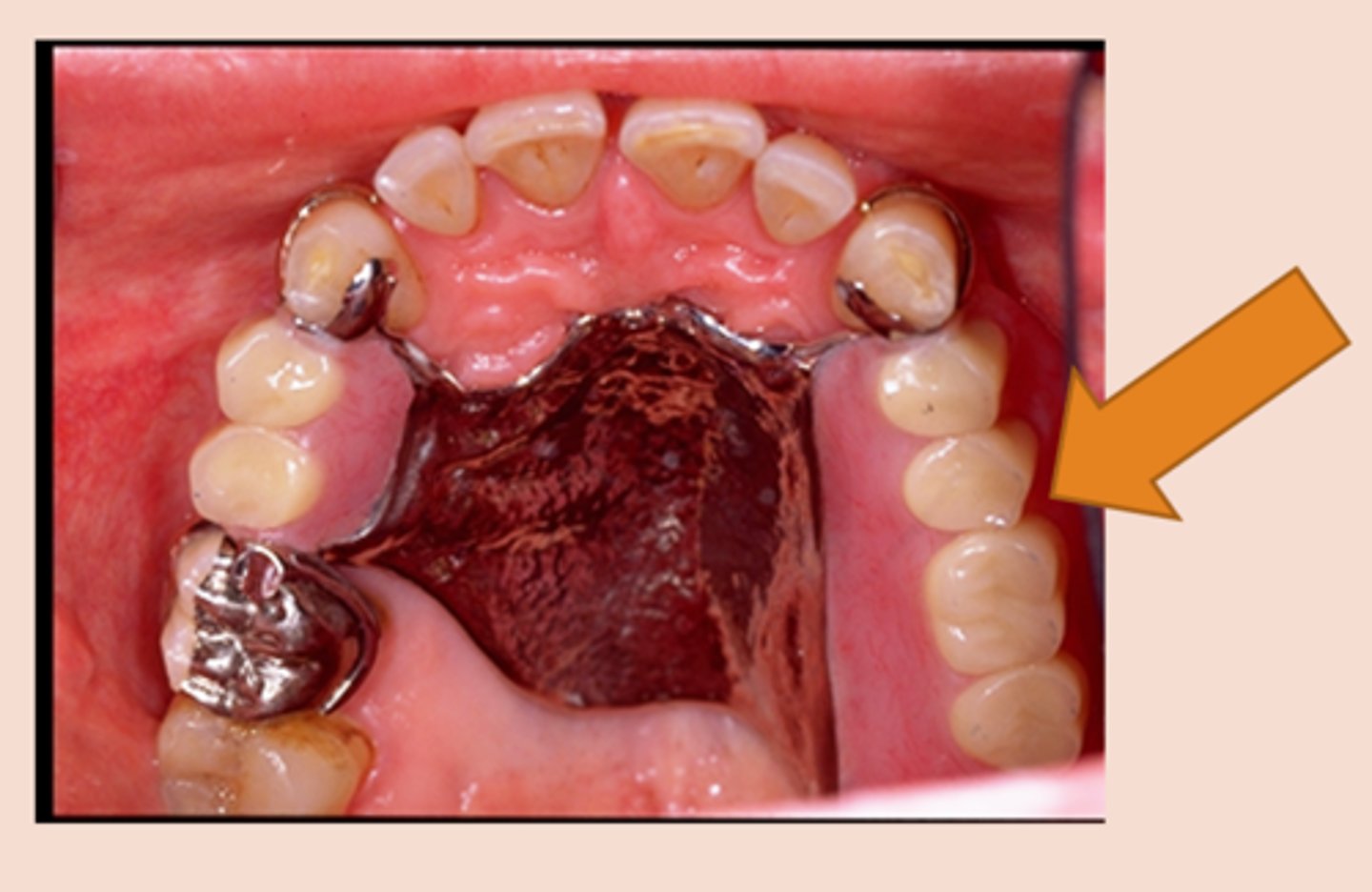 <p>portion of the RPD which replaces teeth and has a mesial abutment only</p>