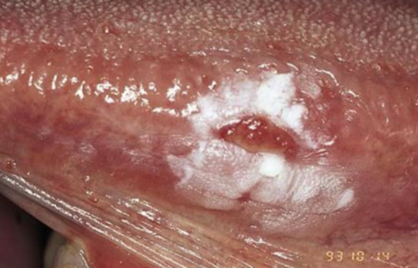 <p>Multifactorial</p><p>&gt;90% of oral cavity cancers*</p><p>Tobacco and alcohol are most common causes **</p><p>Risk increases with age</p><p>increased HPV associated oropharyngeal tumors</p>