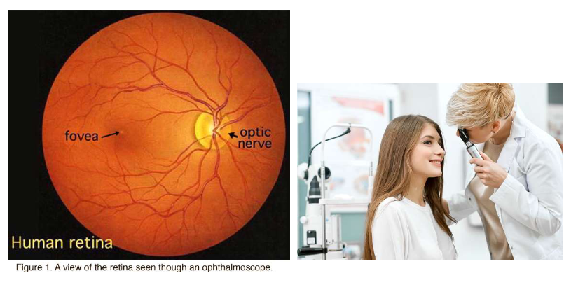 <ul><li><p>ophthalmoscoop gebruiken om naar achterkant van oog te kijken</p><ul><li><p>achterkant oog = fundus</p></li></ul></li><li><p>witte cirkel = papil (optic disc)</p><ul><li><p>punt waar slagaders &amp; aders samenkomen en waar axonen van ganglioncellen het oog verlaten</p></li><li><p>dit deel van netvlies bevat geen fotoreceptoren → blind</p></li><li><p>= blinde vlek (fysiologisch)</p></li></ul></li><li><p>fovea (vlekje van 1,5 mm) → in midden van netvlies</p><ul><li><p>= plek van het scherpe zicht</p></li><li><p>nabij centrum van macula</p></li><li><p>centrale ~0,5 mm van fovea → geen bloedvaten → al het licht kan erdoorheen</p><ul><li><p>geeft holte op de figuur</p></li></ul></li></ul></li></ul><p>→ fundus = enige plaats in lichaam waar men slagaders &amp; aders direct kan zien</p><ul><li><p>belangrijk venster op gezondheid van vaatstelsel van lichaam</p></li><li><p>vasculaire ‘boom’ (= vertakte bloedvaten) spreidt zich op karakteristieke manier uit over netvlies, maar stopt net voor de fovea</p></li></ul><p></p>