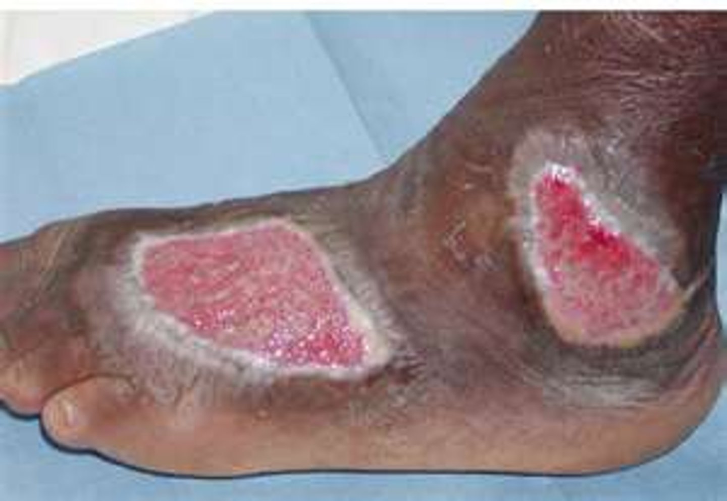<p>softening or dissolution of tissue after lengthy exposure to fluid</p>