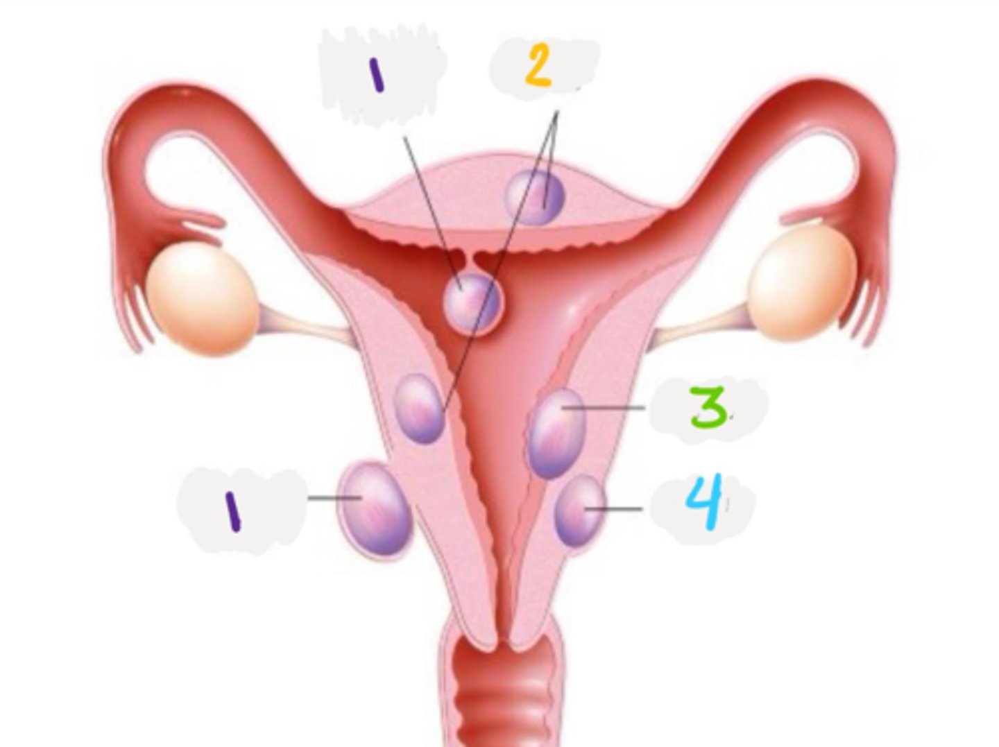 <p>What type of uterine leiomyoma is depicted by #1?</p>