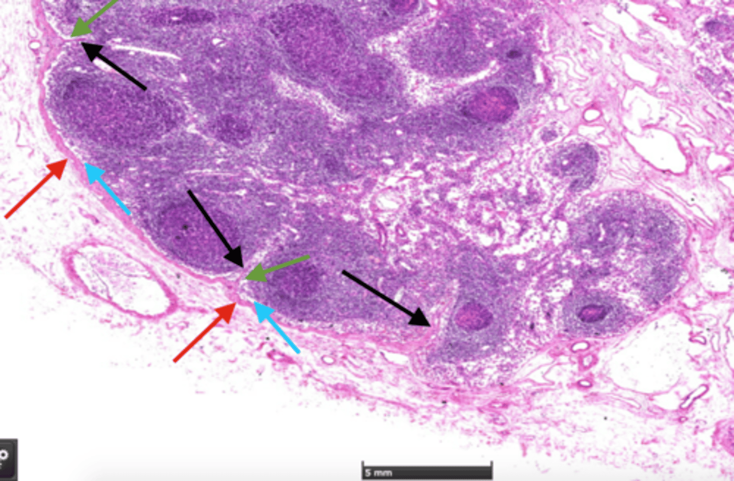 <p>(Green arrow) Sinus of lymph node that run parallel to trabeculae and lead inwards to a labyrinth of medullary sinuses</p>