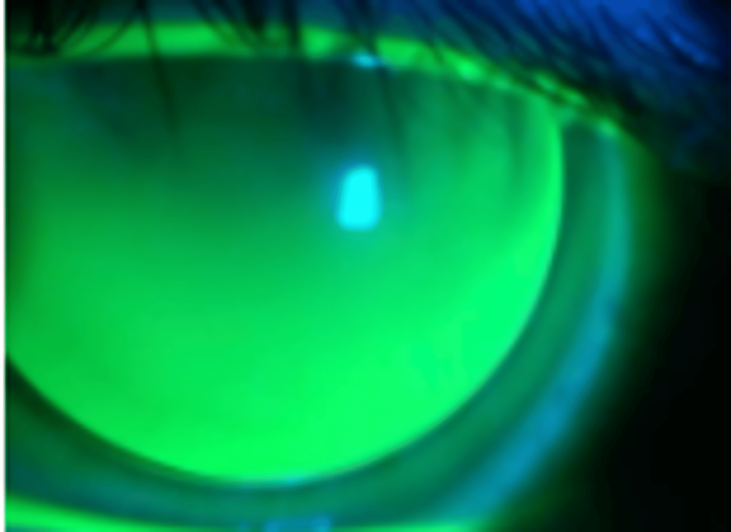 <p>GPCL lid interaction where the lens remains tucked beneath the upper lid and is held in place between blinks. If the upper lid is pulled away, the lens will drop inferiorly.</p>